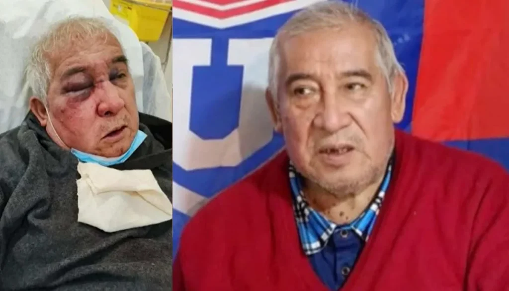 Conserje Agredido en Vitacura Pierde Parte de Su Visión Ocular