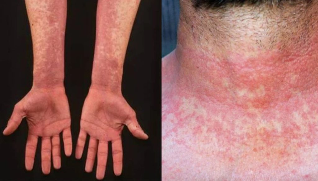 Aumentan casos de escarlatina en Talca: medidas de prevención y cuidados.