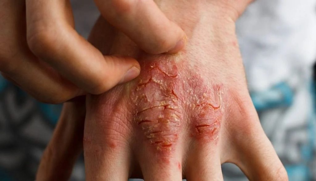 Impacto Económico y Emocional de la Dermatitis Atópica en Chile