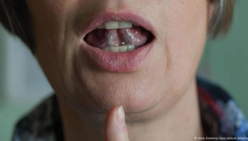 Descubren Vínculo Genético de la Tartamudez con Otros Trastornos