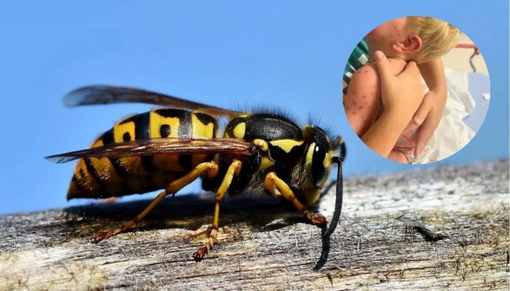 Niño en estado crítico tras múltiples picaduras de avispas