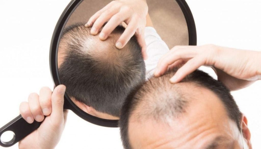 Advertencia del ISP: Riesgos del medicamento contra la calvicie