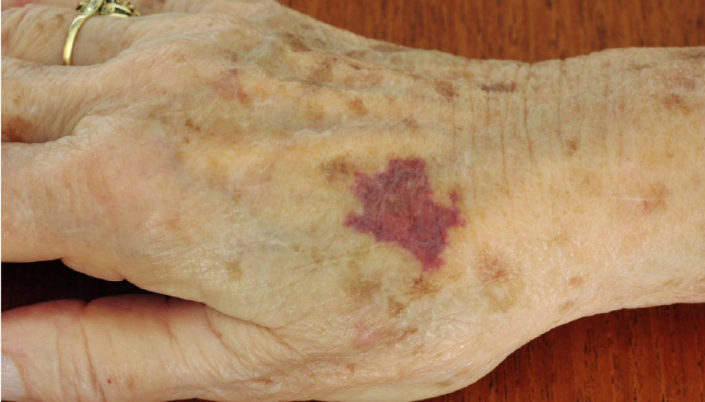 ¿Moretones sin golpes en ancianos? Causas ocultas que debes conocer.