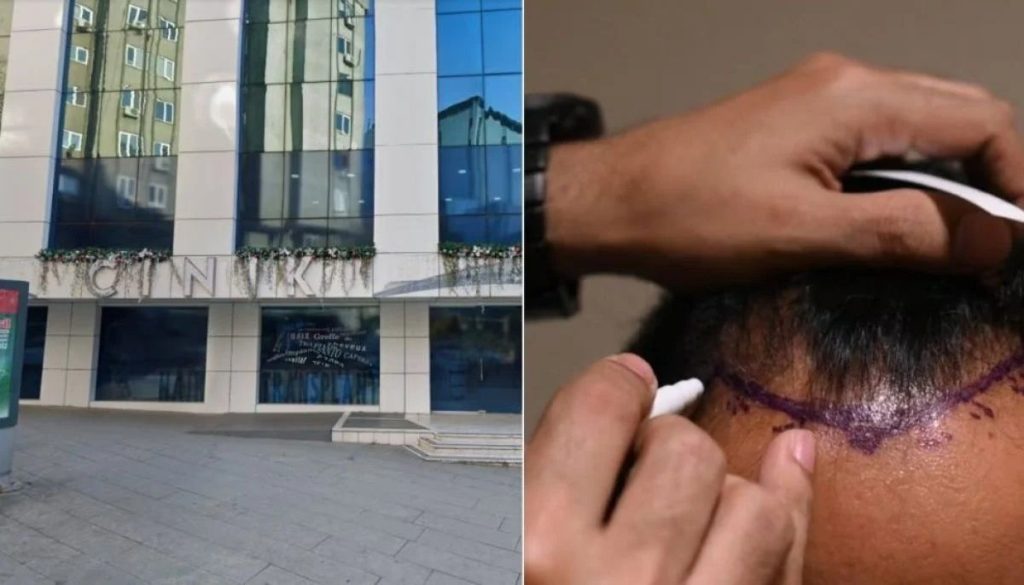 Tragedia en Turquía: turista muere tras trasplante capilar.