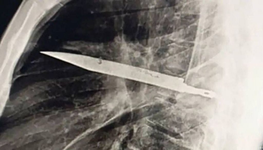 Hombre encuentra cuchillo en su pecho tras ocho años de dolor.