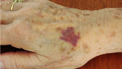 Moretones sin Golpes en Personas Mayores: Causas y Cuidados - ¿Moretones sin golpes en ancianos? Causas ocultas que debes conocer.